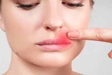 Заеды в уголках рта – дефицит железа в организме?