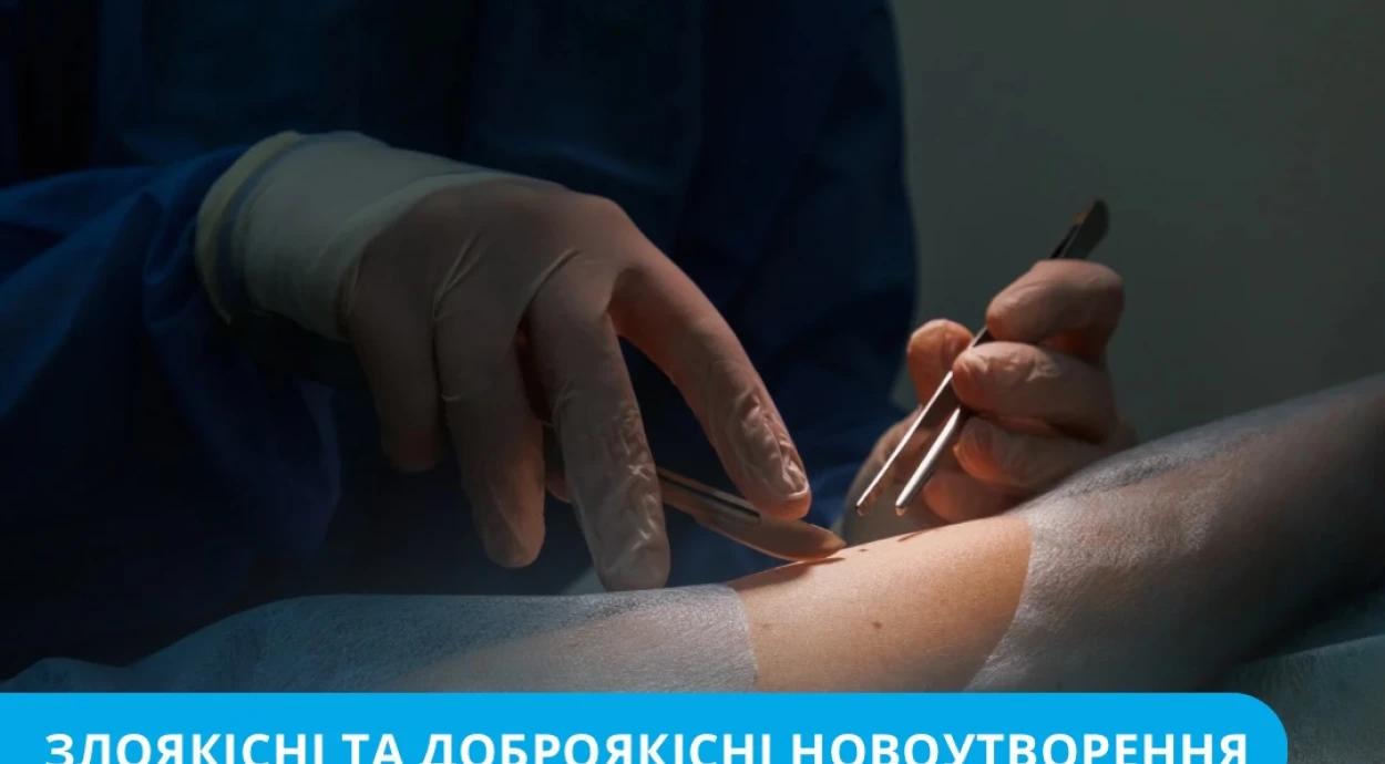 Чи варто видаляти дивну родимку або що таке симптом «гидкого каченяти»?