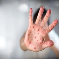 «Дитячі інфекції» в дорослих: особливості перебігу кору та ризики ускладнень
