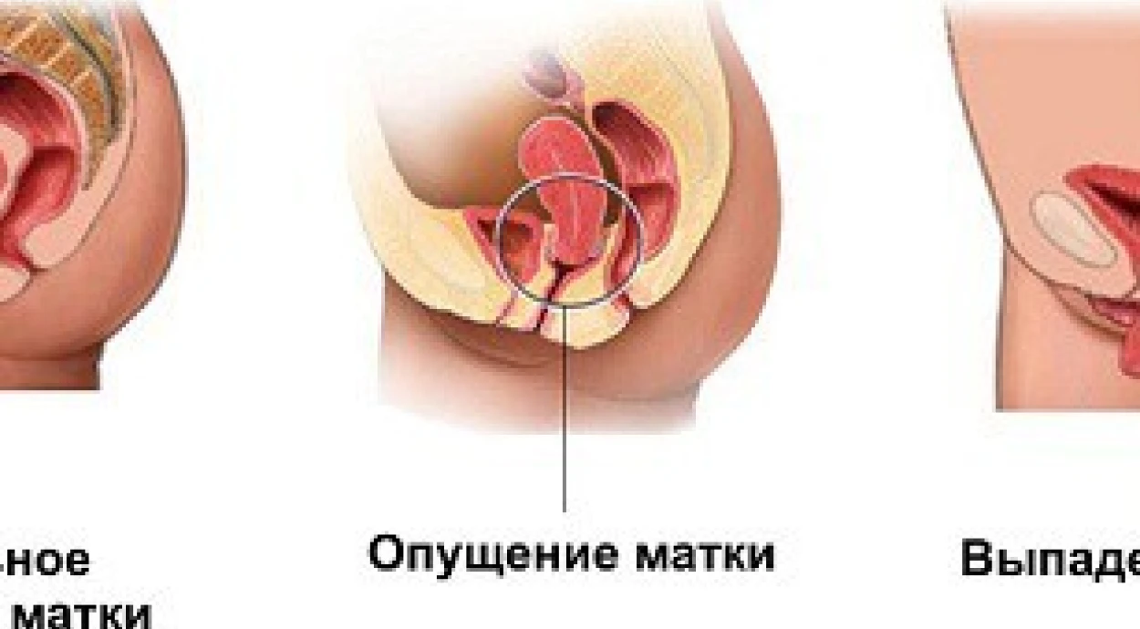 Пролапс (опущення, випадіння) тазових органів у жінок