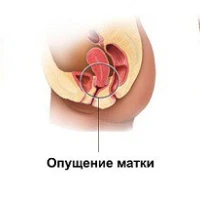Пролапс (опущення, випадіння) тазових органів у жінок