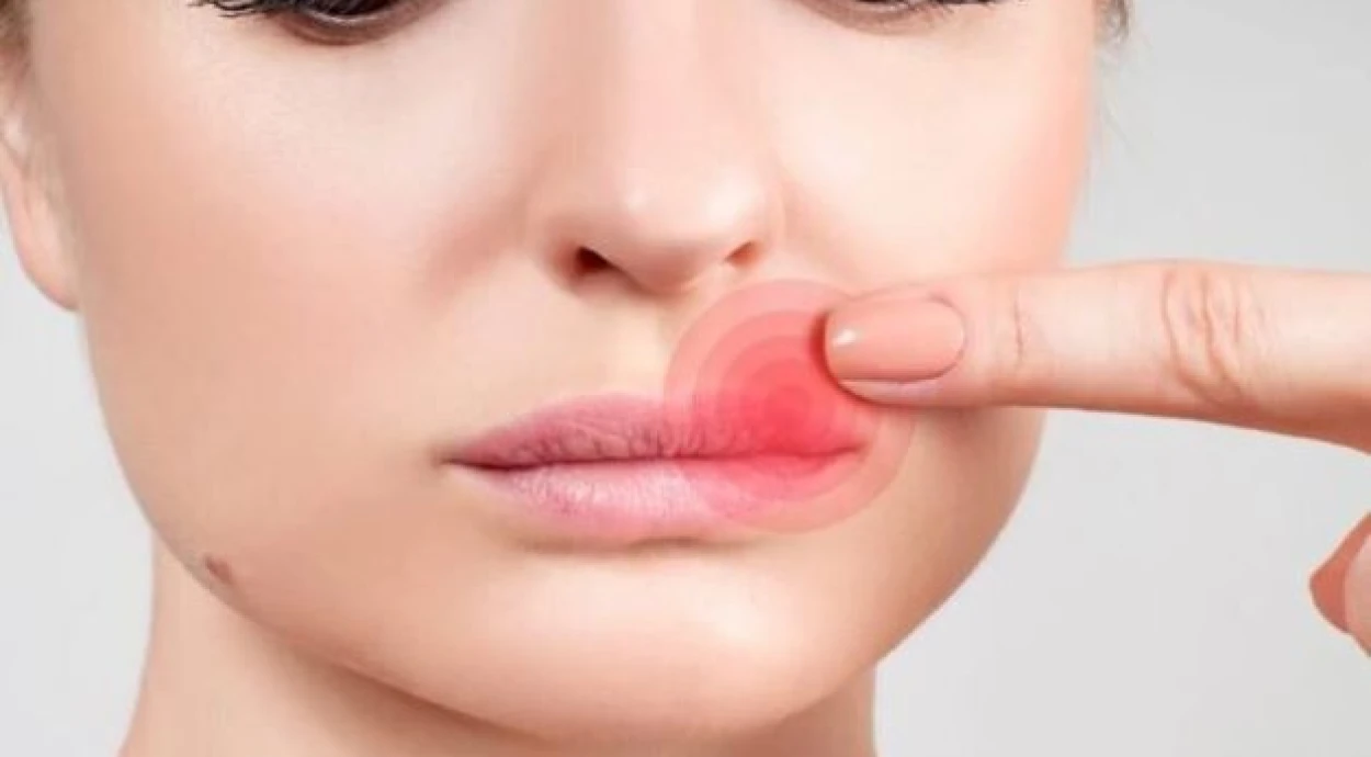 Заїди в кутиках рота – дефіцит заліза в організмі?