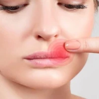 Заїди в кутиках рота – дефіцит заліза в організмі?